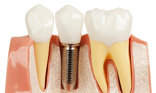 Diş çəkilən anda implant yerləşdirilə bilərmi?